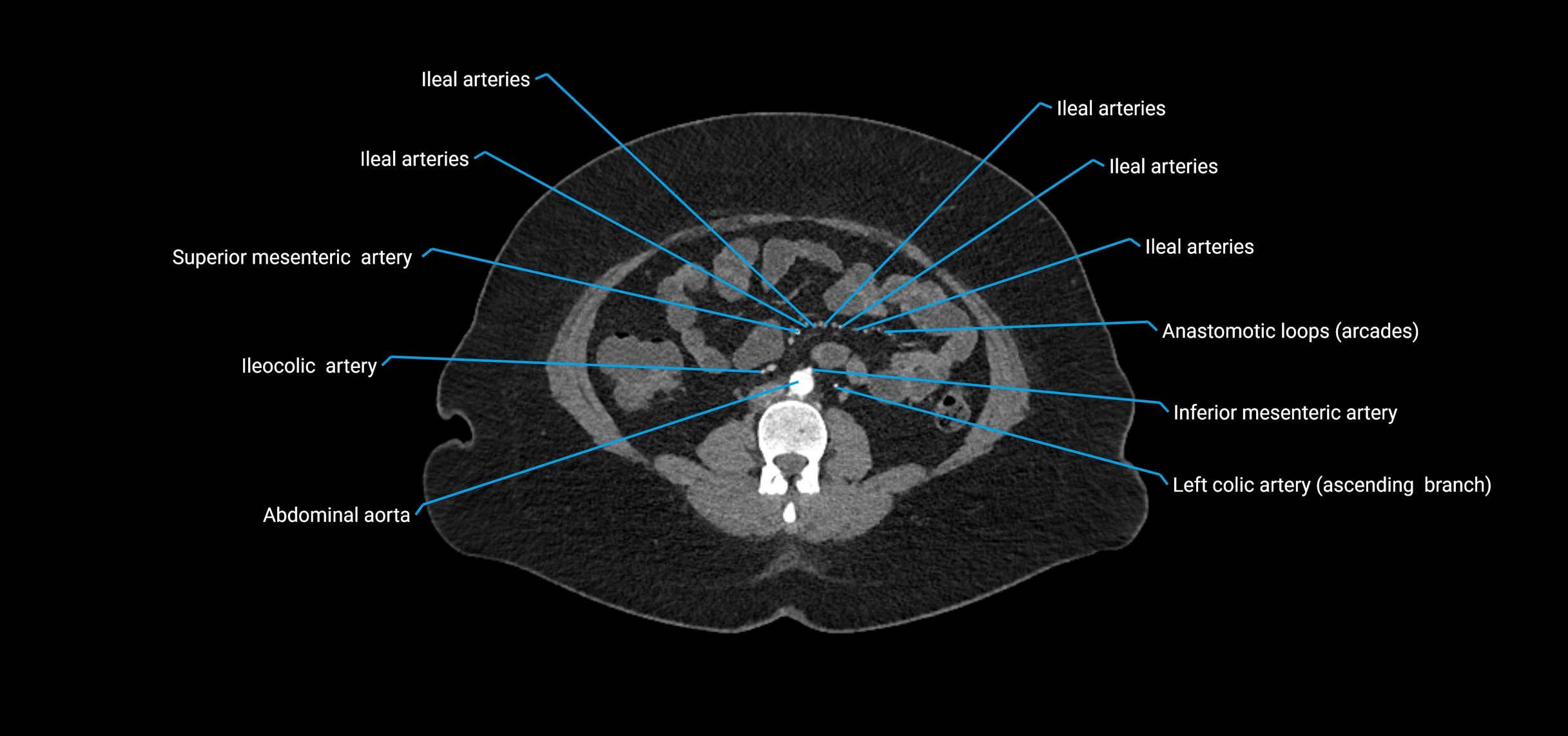 CTA abdomen axial cross sectional anatomy labelled image_110 (2).webp